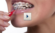 Caring for braces video